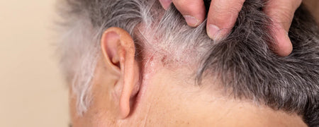 Psoriasis hovedbund: Hvordan man lindrer symptomerne