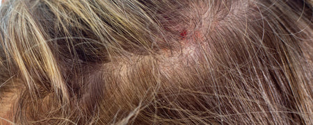 Inflammation i hovedbunden: Årsager, naturlige behandlinger og forebyggelse