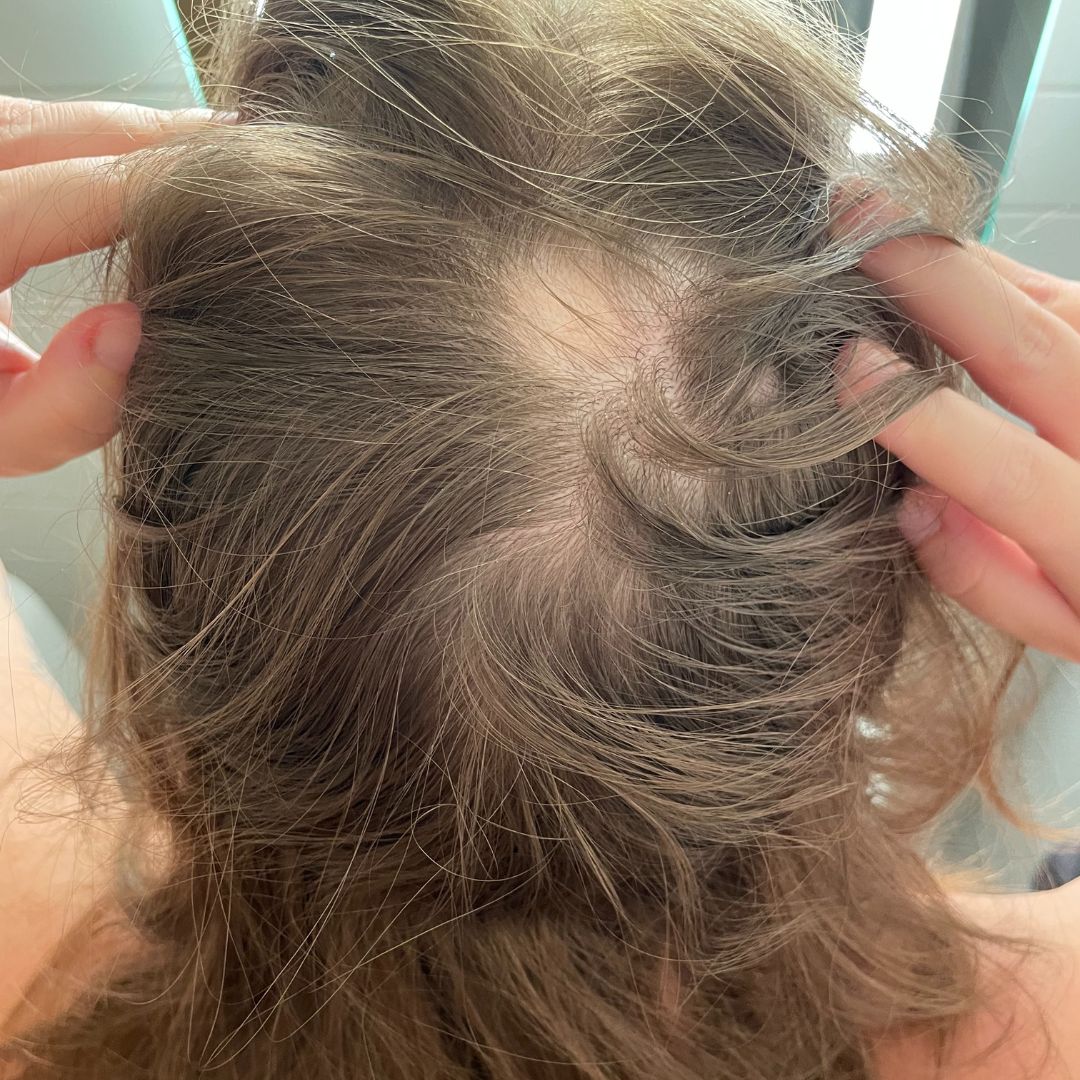 Before - Frederikke K.